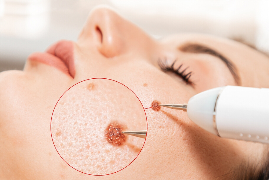 Electrocautery Wart Removal in the face